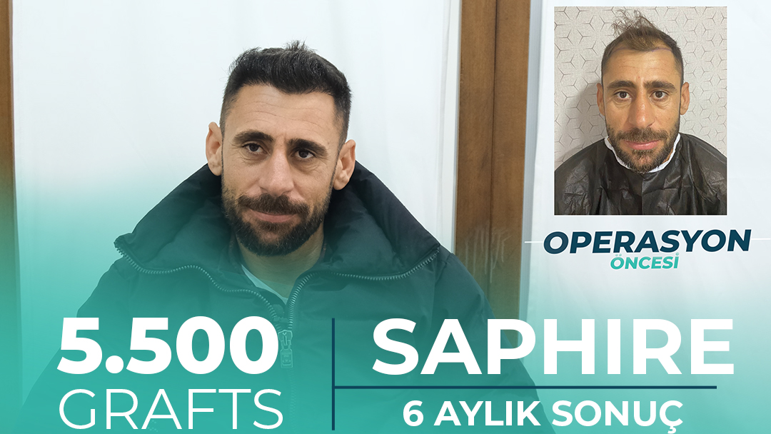 Safir FUE Saç Ekim Sonuçları